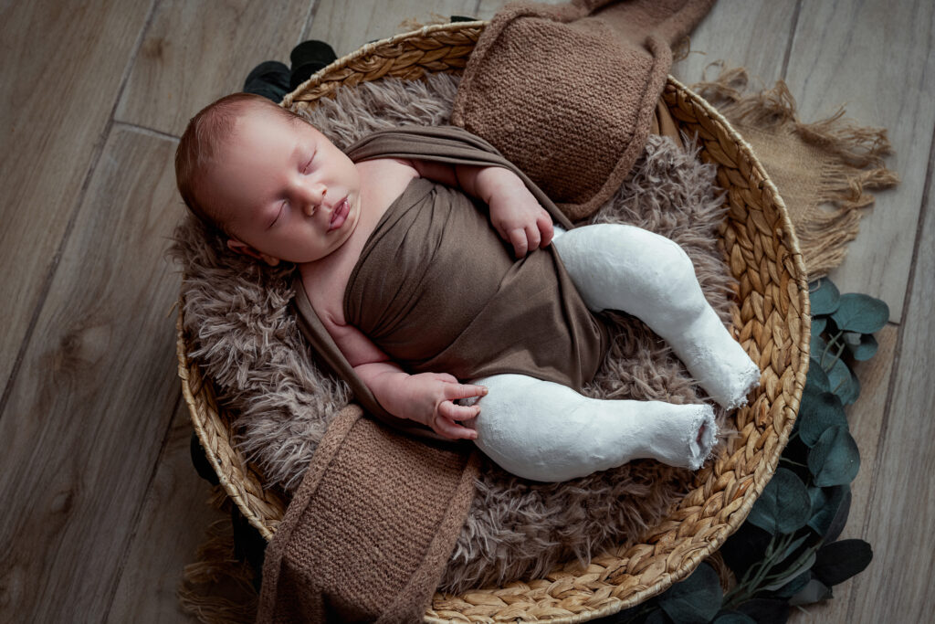 Séance photo nouveau né , bébé plâtre aux jambes 